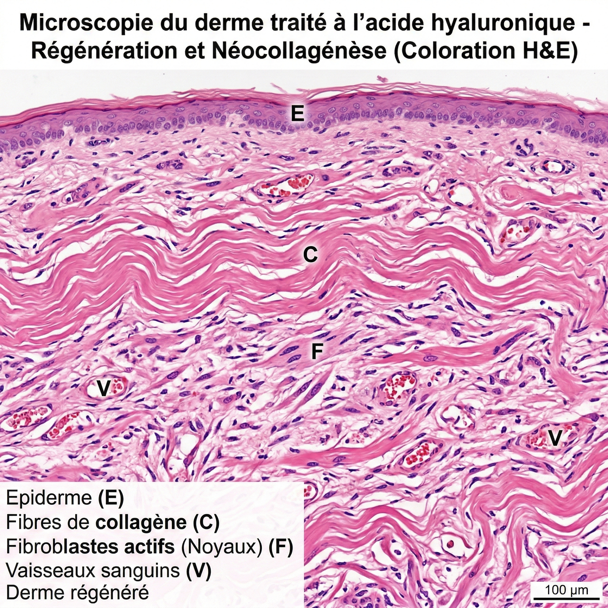 Microscopie d'un derme traité à l'acide hyaluronique montrant la régénération